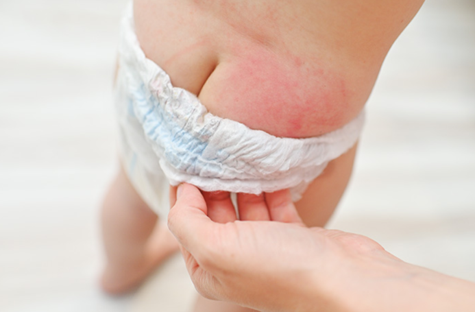 Ruam Popok Bayi Tidak Kunjung Sembuh? Ini Penyebab dan Solusinya